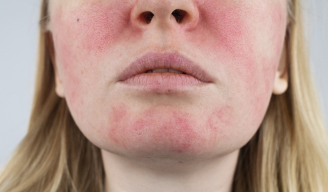 Redness and Vascular Visibility