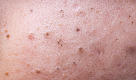 Blackhead and Oil Control