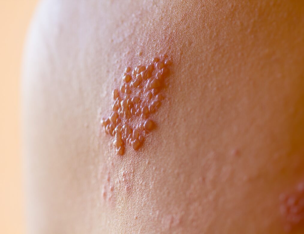Painful or itchy blisters or sores