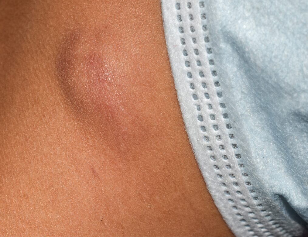 Swollen lymph nodes in the groin