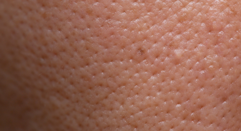 Enlarged Pores and Oil Imbalance