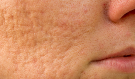 Mild Pigmentation and Textural Irregularities