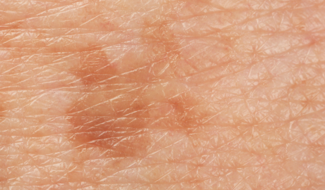 Pigmentation and Redness Reduction