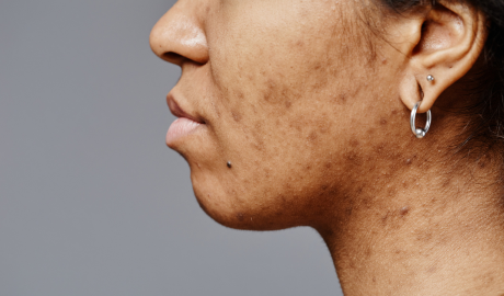 Dullness and Uneven Tone